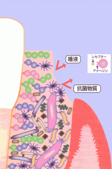 はがれている歯周ポケット内の細菌