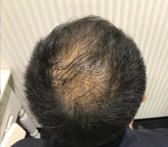 施術前