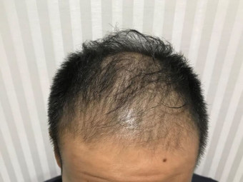 施術前