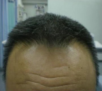 施術後