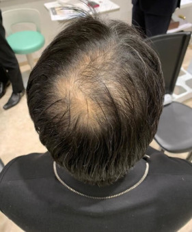 施術前